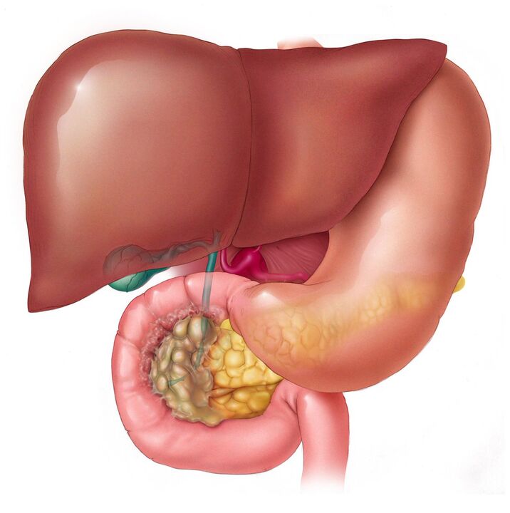 How to remove the parasites from the liver